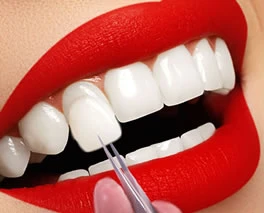 Veneers 