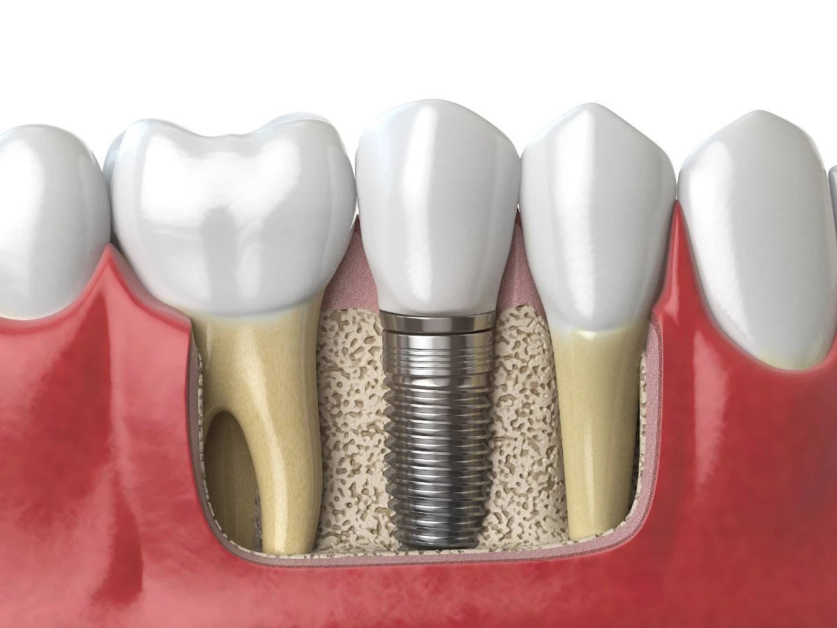 ilustracija-zubnih-implantata