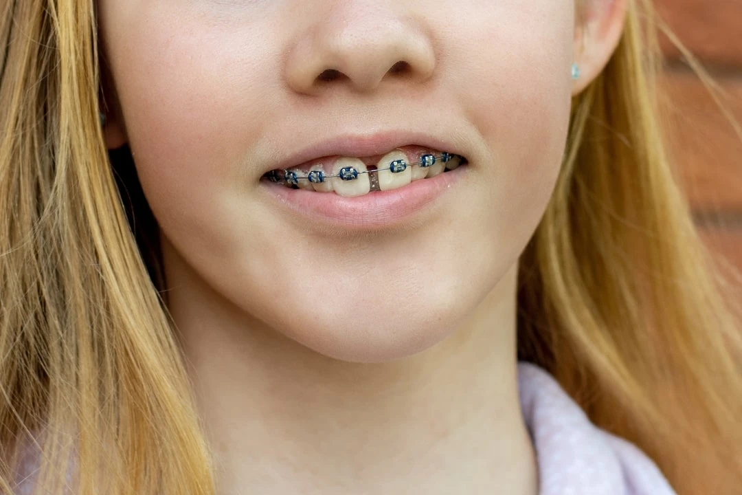 Tinejdzerka nosi fiksnu protezu kako bi resila problem razmaka izmedju zuba.